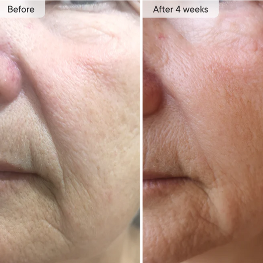 Micro-Infusion Targeted Patches